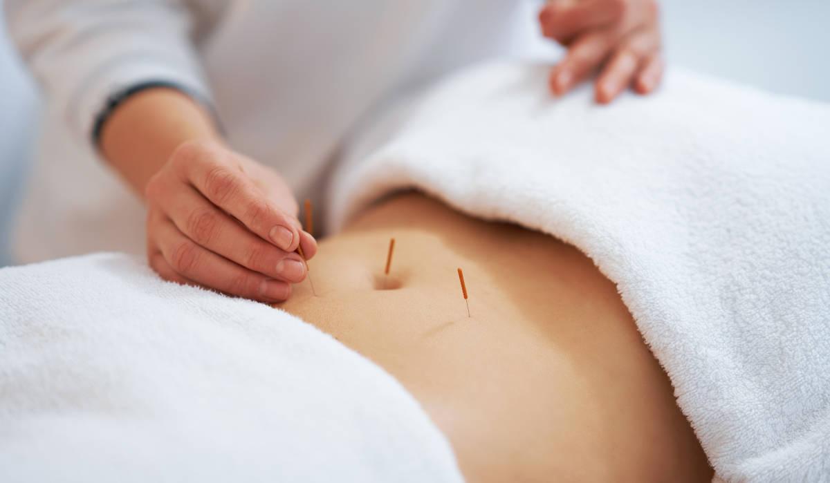 Wanita dengan terapi akupuntur